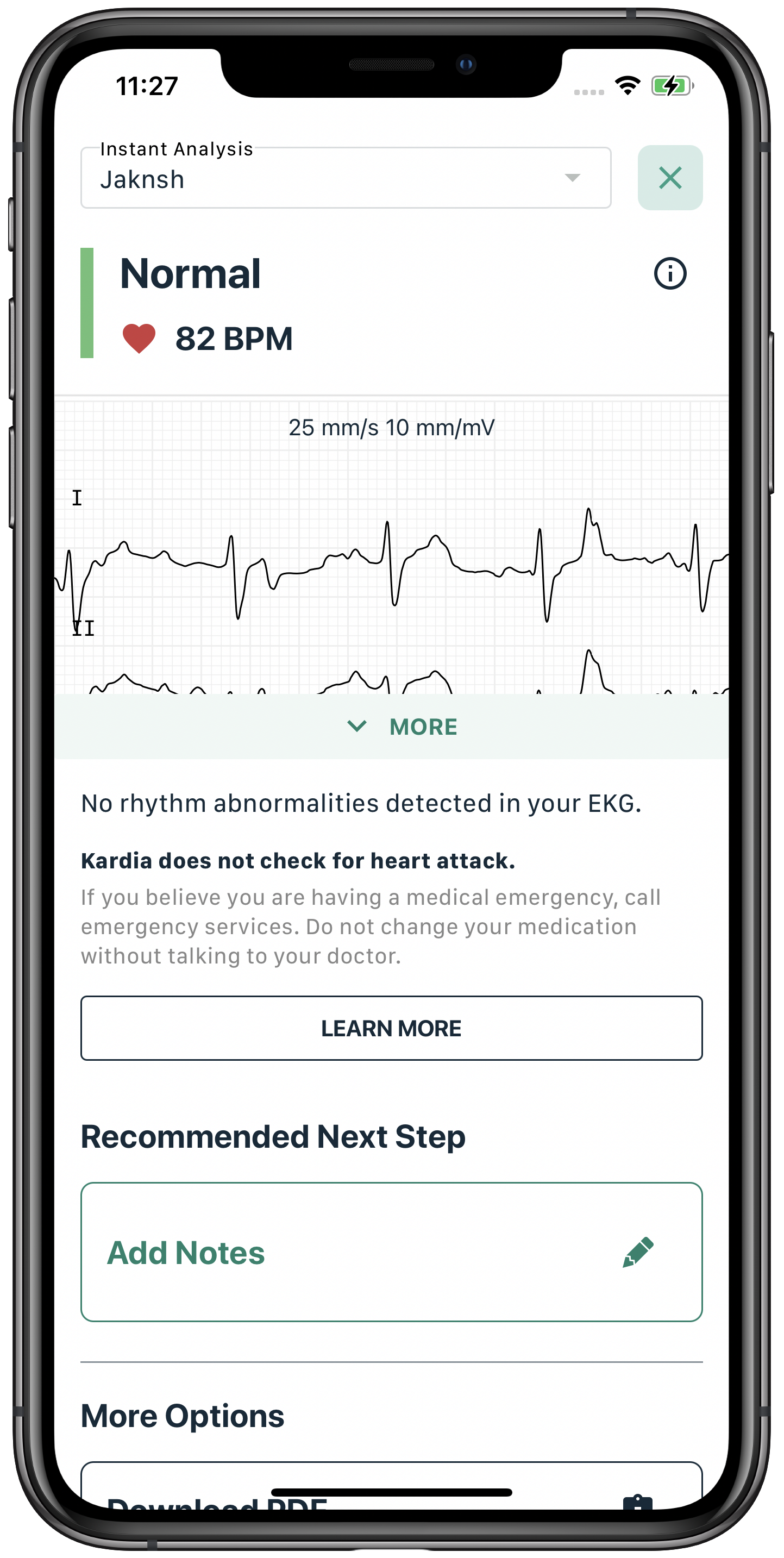 Wynik EKG w aplikacji Kardia